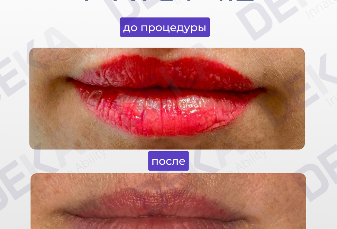 Галерея - Удаление татуажа на лазерном аппарате LUXEA